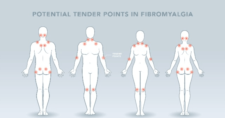 Fibromyalgia- tender points