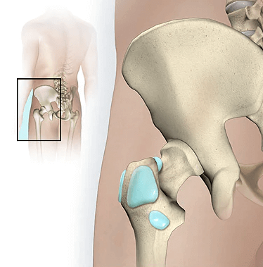 Hip bursitis or trochanteric bursitis